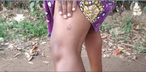 Mubende Residents In Panic Mode Following An Outbreak Of Strange Disease That “Leaves Numbers” On The Skin